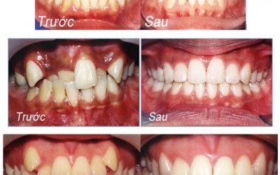 Tổng hợp những câu hỏi đáp về răng miệng