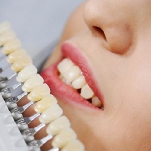 Cảm nhận của chị Hồng sau khi trồng răng sứ